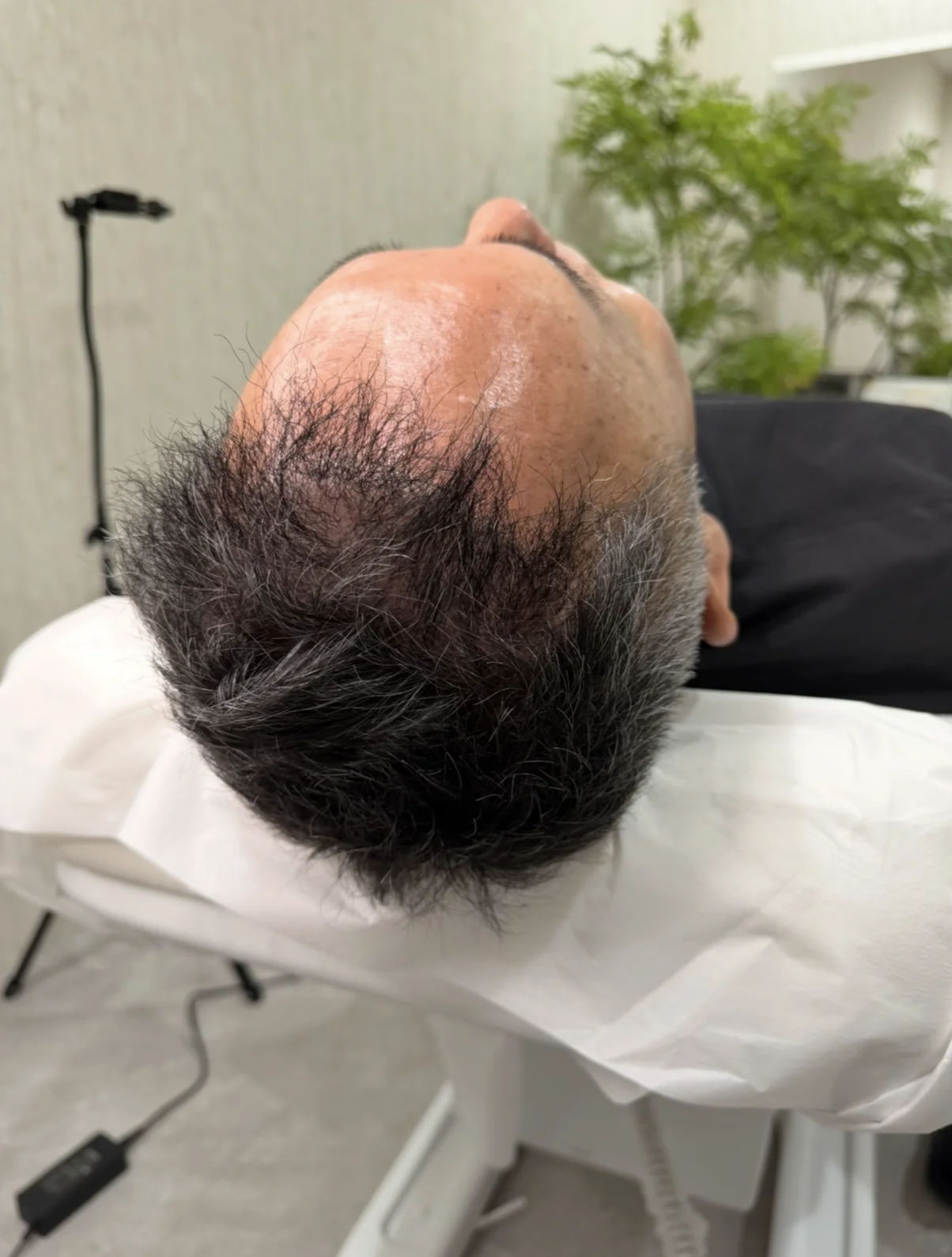 植毛後のFUE傷跡 施術前