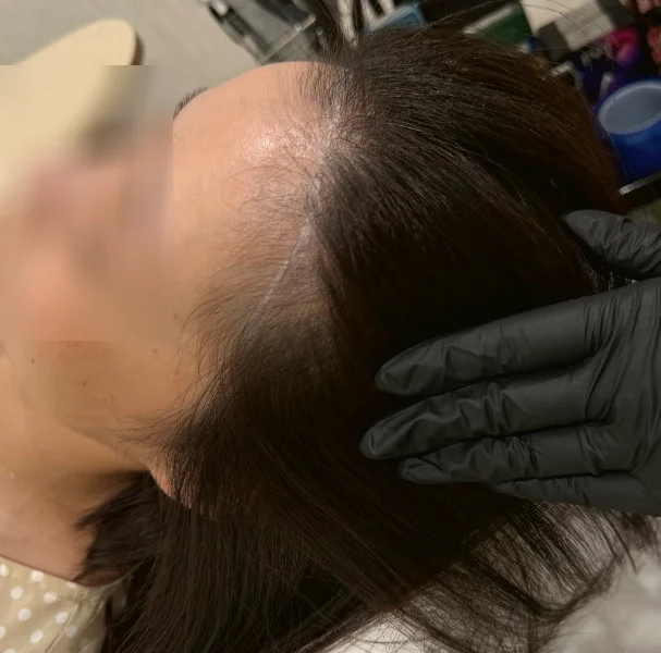 生え際 施術前