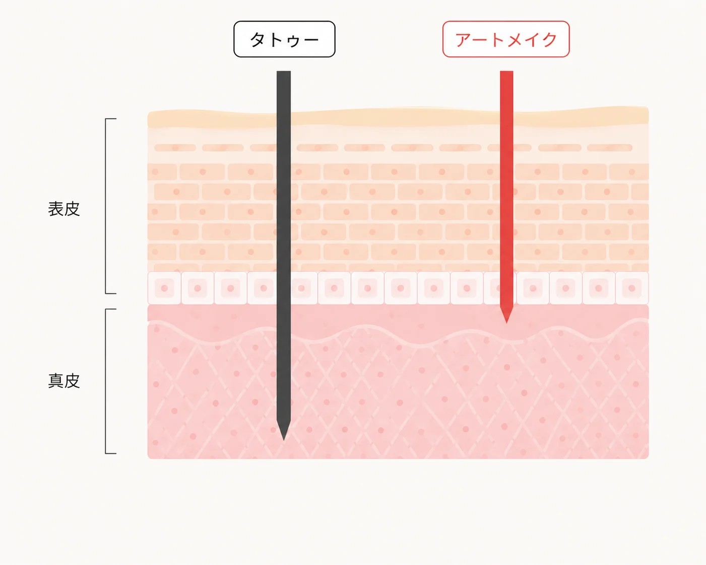 タトゥーより浅い層に色素を入れる断面図