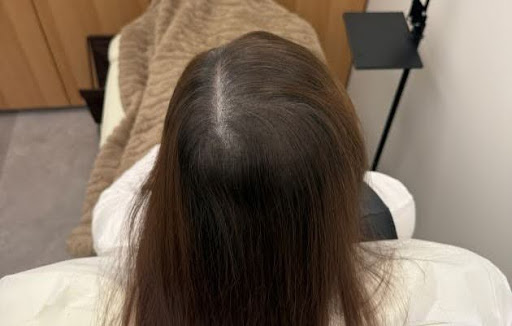 つむじ周辺の地肌の透け感が気になる女性のAfterの写真